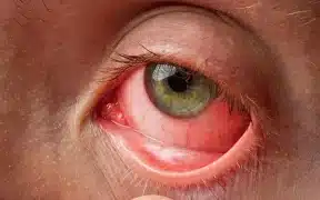Lahore Faces Alarming Surge in Contagious 'Pink Eye' Cases