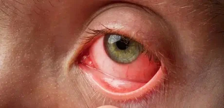 Lahore Faces Alarming Surge in Contagious 'Pink Eye' Cases