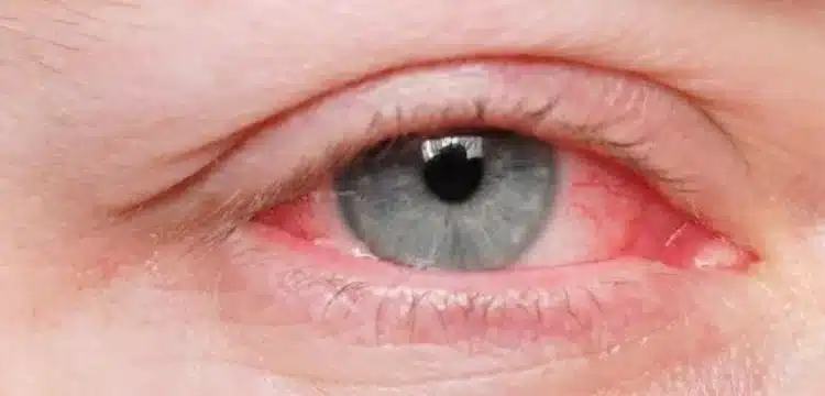 Punjab Reports 10,000+New Pink Eye Cases In One Day