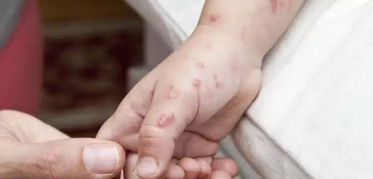 KP Hospitals On Alert Due To Increasing Chickenpox Cases