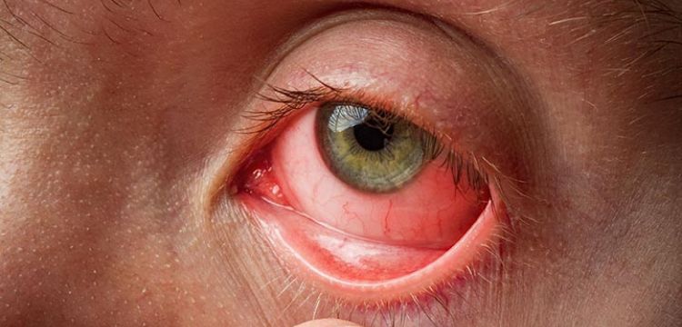 Pink Eye Syndrome: Causes, Symptoms, Prevention, and Treatment in Pakistan