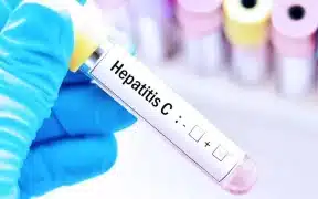 Hepatitis C May Soon Top Global Viral Deaths Cause