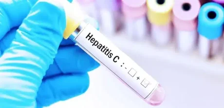 Hepatitis C May Soon Top Global Viral Deaths Cause