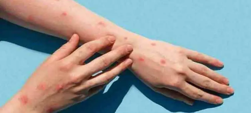 Monkeypox cases in Pakistan increase to three