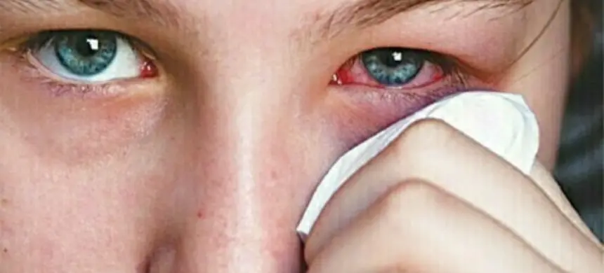 Punjab is experiencing a rise in cases of pink eye