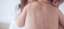 Measles Cases In South Korea Hit Six-Year High Amid Global Resurgence