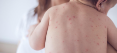 Measles Cases In South Korea Hit Six-Year High Amid Global Resurgence