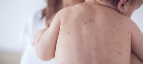 Measles Cases In South Korea Hit Six-Year High Amid Global Resurgence