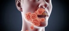 Silent Mouth Threat: Recognize Oral Cancer Warning Signs
