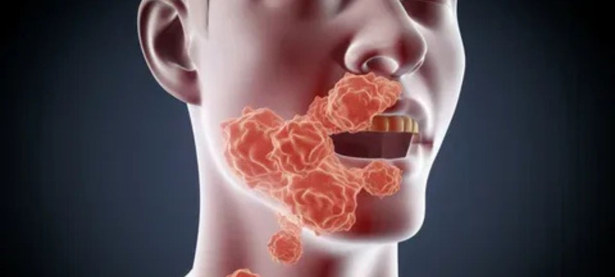 Silent Mouth Threat: Recognize Oral Cancer Warning Signs