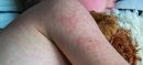 53 Children Die in Sindh Amid Measles Outbreak