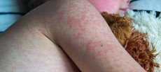 53 Children Die in Sindh Amid Measles Outbreak