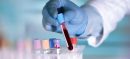 Scientists Discover Blood Test That Could Predict Lung Cancer