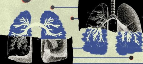 13 Lung Cancer Myths Experts Say You Should Stop Believing